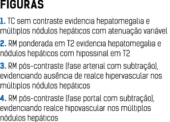 FIGURAS 1  TC sem contraste evidencia hepatomegalia e m ltiplos n dulos hep ticos com atenua  o vari vel 2  RM ponder   