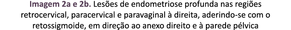Imagem 2a e 2b. Les es de endometriose profunda nas regi es retrocervical, paracervical e paravaginal  direita, ader...