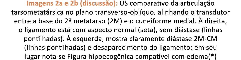Imagens 2a e 2b (discuss o): US comparativo da articula o tarsometat rsica no plano transverso obl quo, alinhando o ...